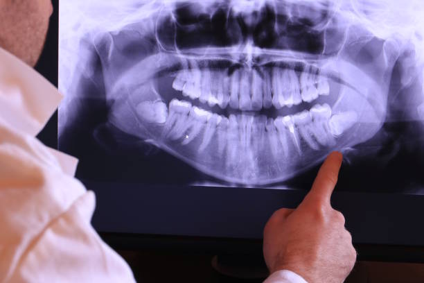 Best Emergency Tooth Extraction in Browns Point, WA